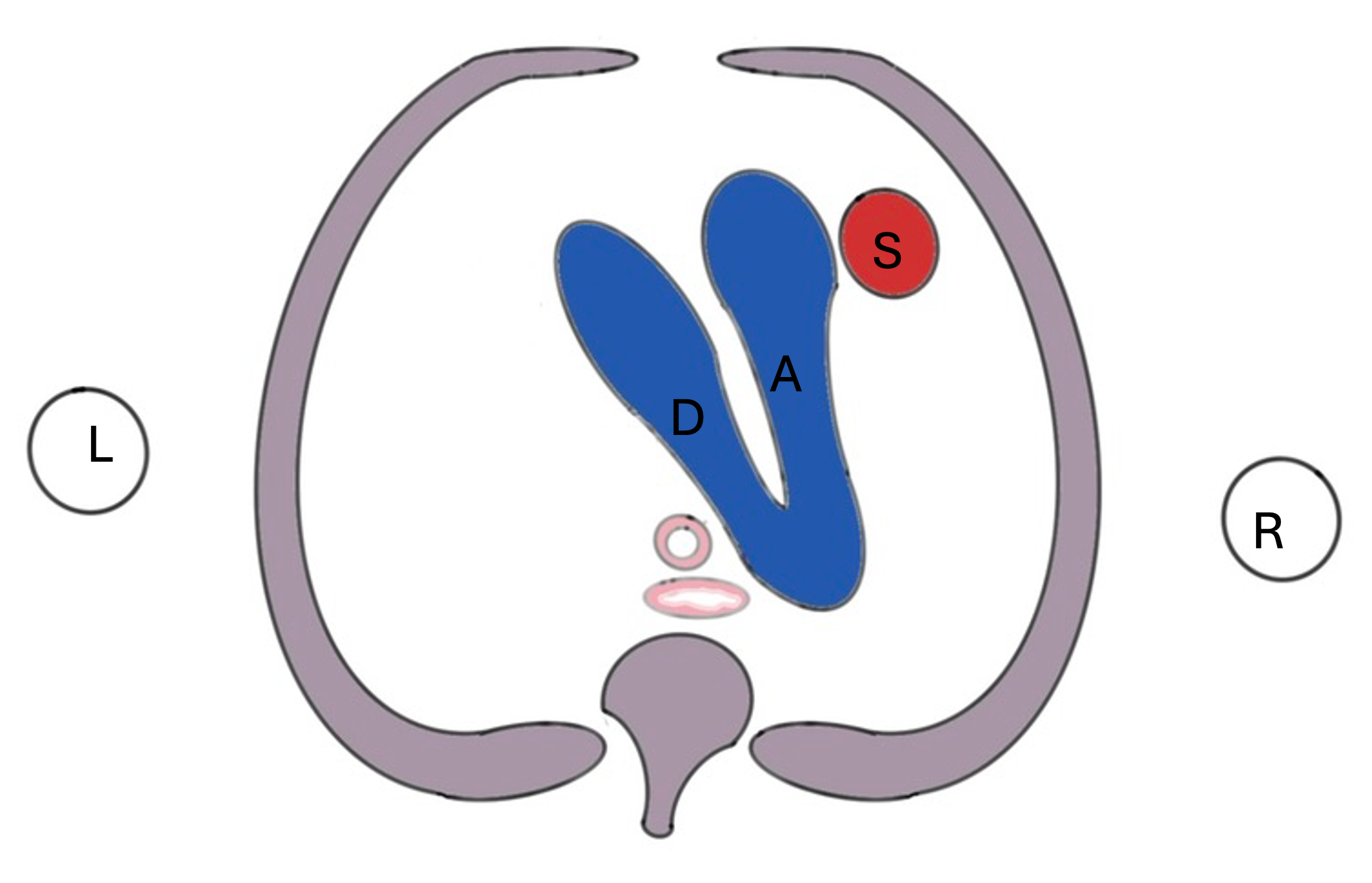 Exploring the V, U, and Y of the VT3 View – Fetal Cardiac Care