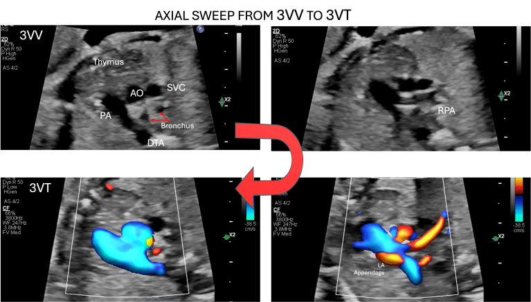 Fetal Branch Pulmonary Artery Doppler: Technique, Interpretation, and ...